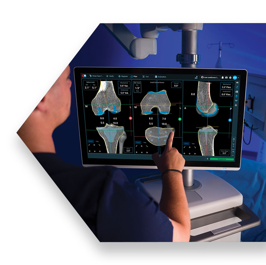 Surgeon using ExcelsiusFlex with ExcelsiusHub in foreground