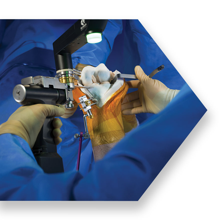 Surgeons using ExcelsiusFlex