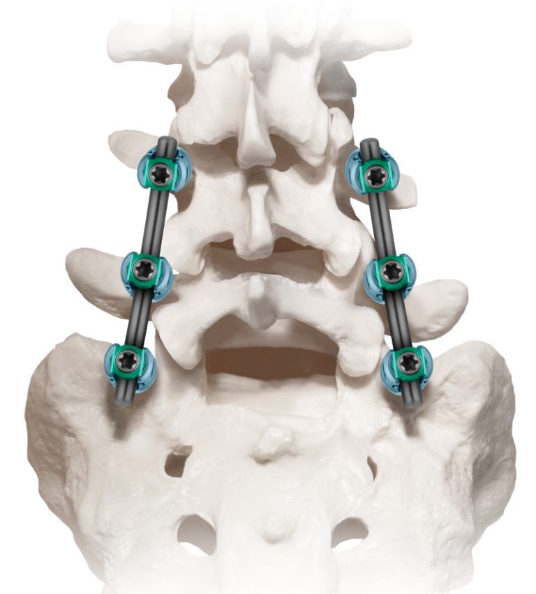 Posterior Lumbar Interbody Fusion Surgery Globus Medical 