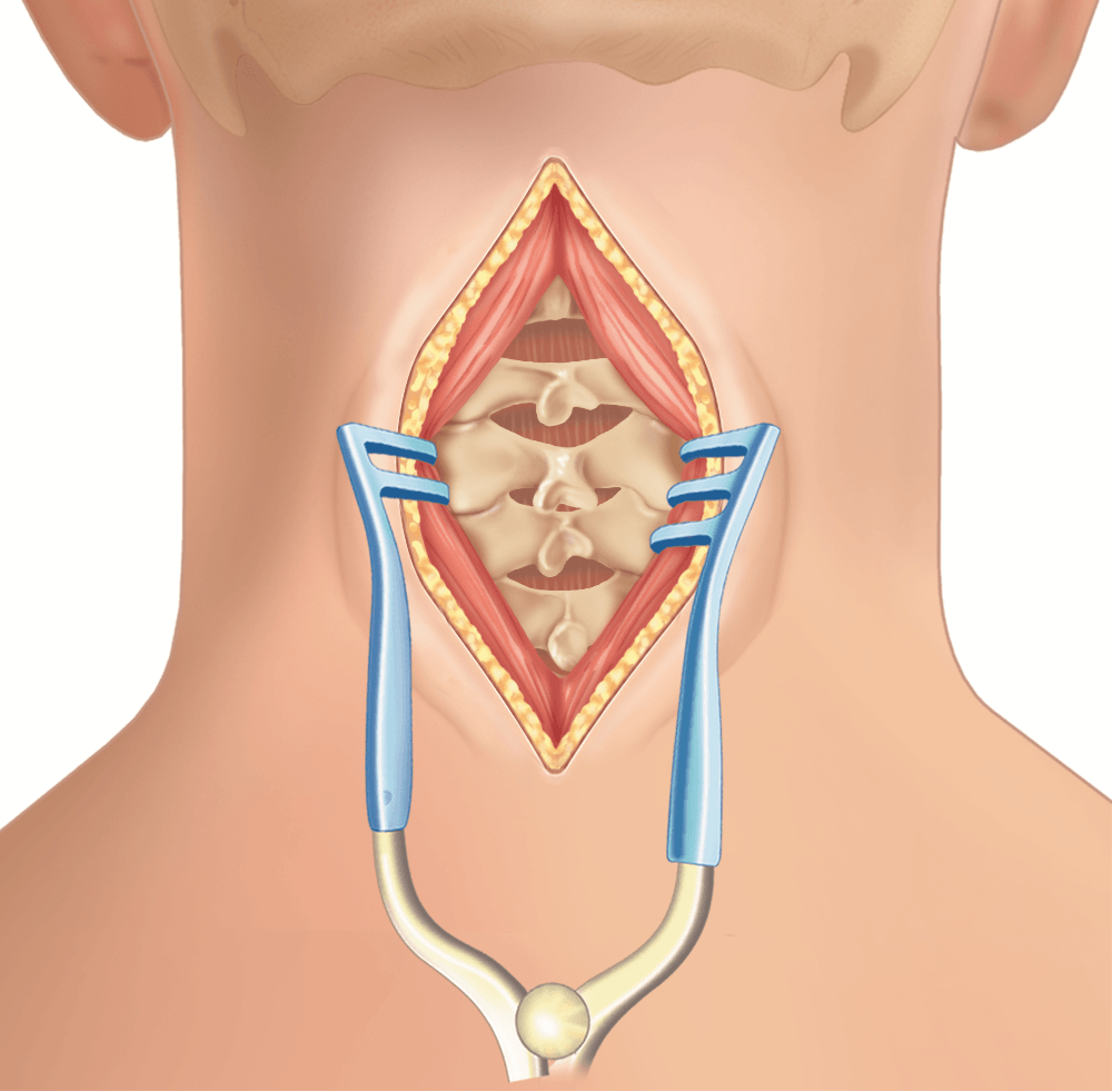 Posterior Cervical Fusion Procedure Globus Medical