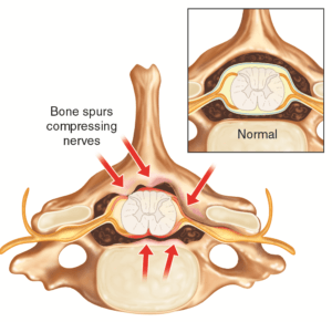 Posterior Cervical Fusion Procedure | Globus Medical