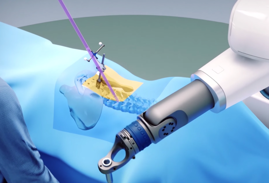 Robotic Spine Surgery For Patients Globus Medical