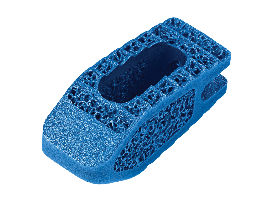 HEDRON P™ 3D Printed PLIF spacer | Globus Medical